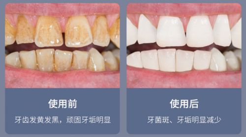 告別刷牙盲區(qū)，現(xiàn)代口腔護(hù)理新選擇 為何它能解決你的深層困擾